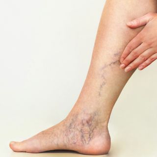 Prevenzione della formazione di nuove varici